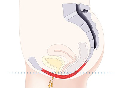 Pelvic-Floor Muscle Repair 5 Pelvic floor muscles Southend-on-Sea