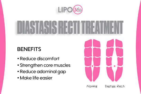 Revolutionising Muscle Repair: The Power of LIPO360 Body Sculpt Post-Injury 5 diastasis recti treatment Southend-on-Sea