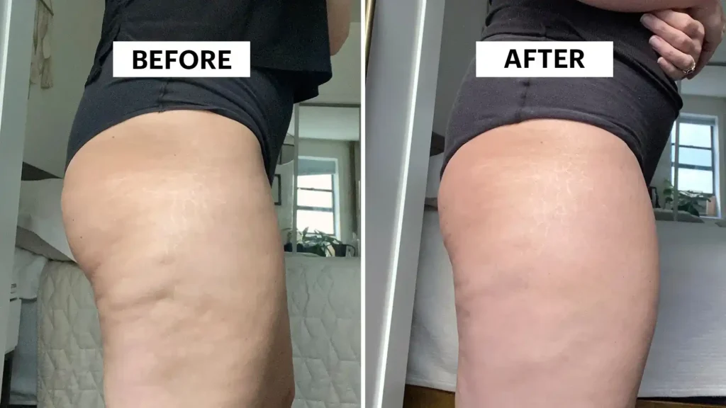 Sculpting Your Bum: Can Toning Exercises Really Reduce Cellulite? 1 Do Toning Exercise Southend-on-Sea Really Tackle Cellulite?