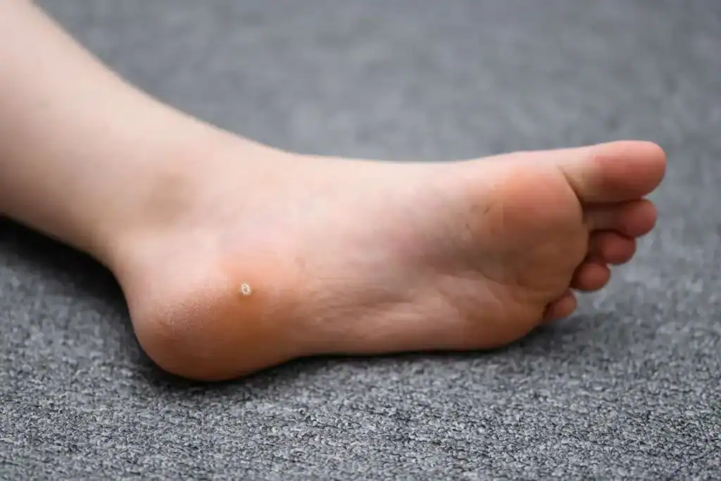 Cryotherapy For Warts And Also Verrucas 2 Image of verruca on the bottom of the foot that able to be treated with Cryotherapy Southend-on-Sea