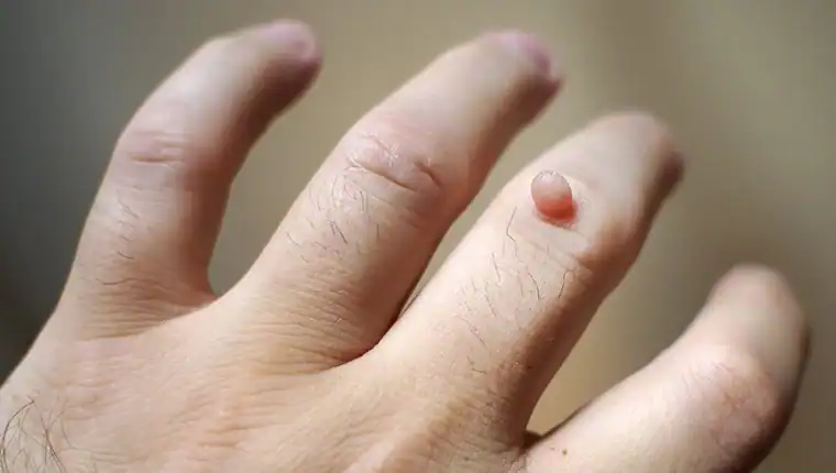 Image of blemish that Cryotherapy Southend-on-Sea can remove with Lipo 360.