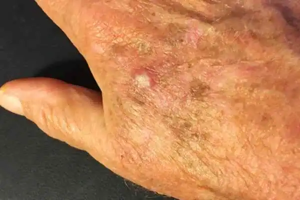 Cryopen For Actinic Keratoses 1 Image of Actinic keratoses Southend-on-Sea on a person hand