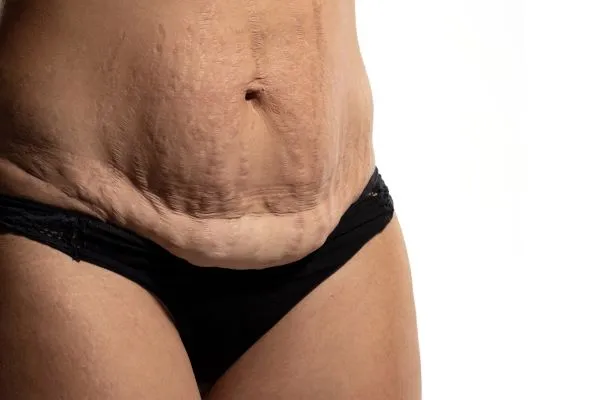 The science behind skin tightening Southend-on-Sea picture of a woman's sagging skin on the stomach